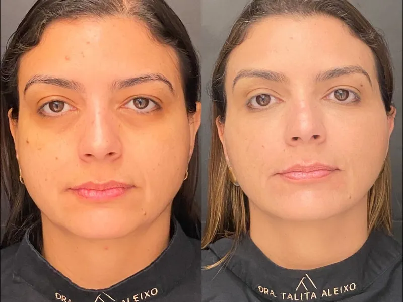 Antes e depois de rinoplastia em vista frontal