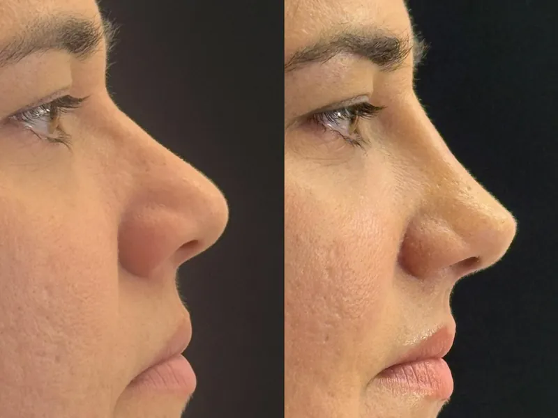 Antes e depois de rinoplastia de perfil, com o dorso do nariz mais reto