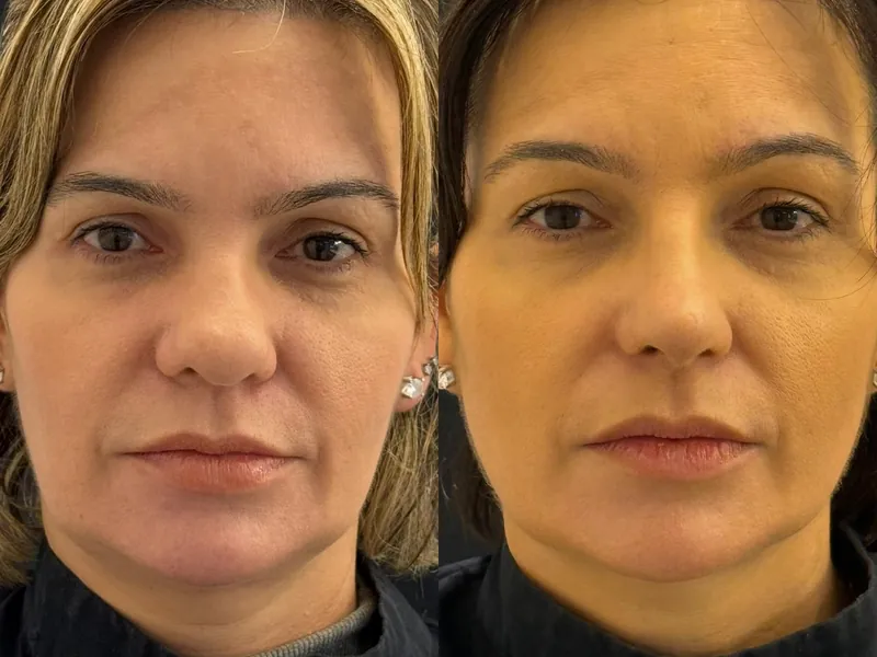 Antes e depois de rinoplastia em vista frontal, com a base do nariz mais estreita