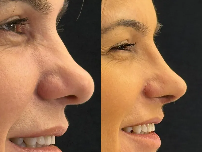 Antes e depois de rinoplastia de perfil, sorrindo, com a ponta do nariz mais definida