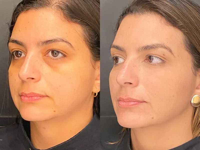 Antes e depois de rinoplastia em vista de três quartos, com o nariz mais proporcional ao rosto