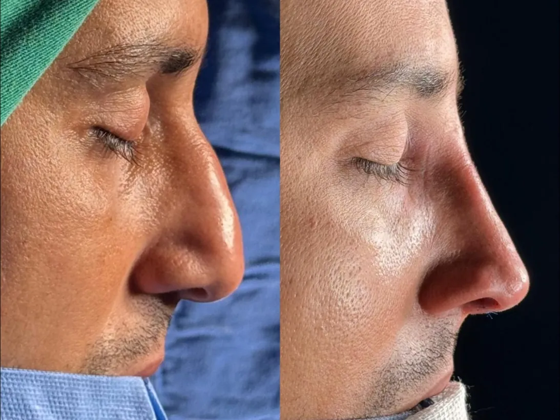 Antes e depois de rinoplastia masculina de perfil
