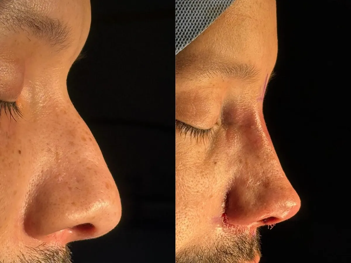 Antes e depois de rinoplastia masculina de perfil, no centro cirúrgico