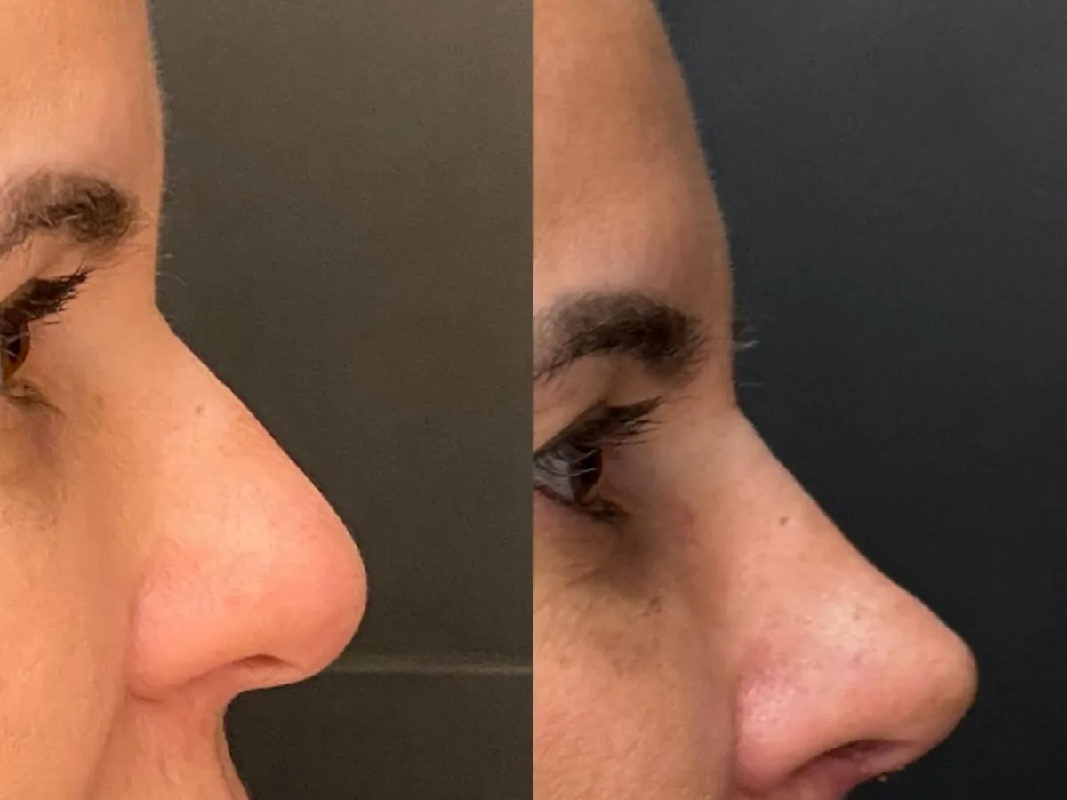 Antes e depois de rinoplastia estruturada de perfil