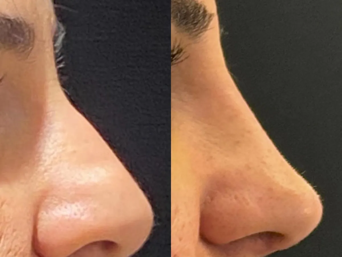 Antes e depois de rinoplastia de perfil, aproximado no nariz
