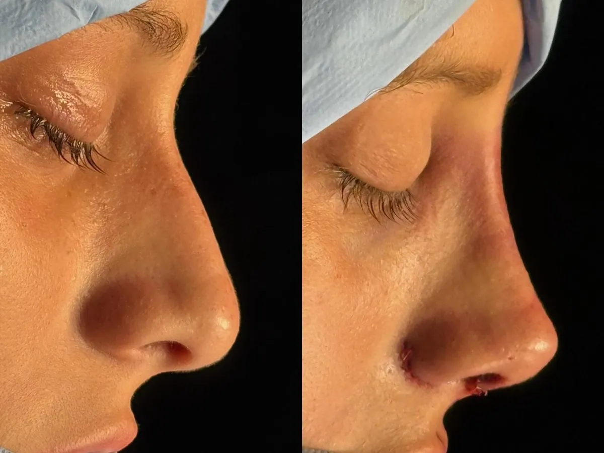 Antes e depois de rinoplastia de perfil, no centro cirúrgico